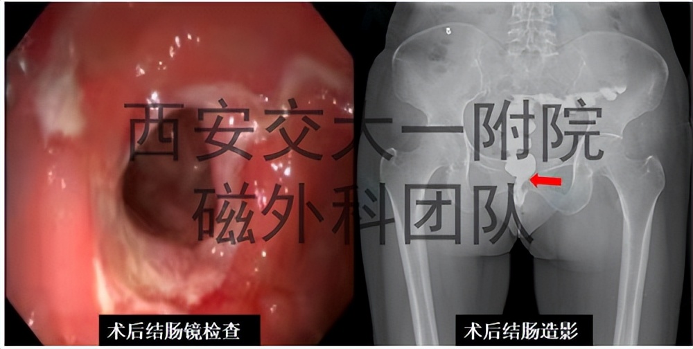 “小磁环”巧解大难题西安交大一附院应用S形磁环治疗直肠狭窄