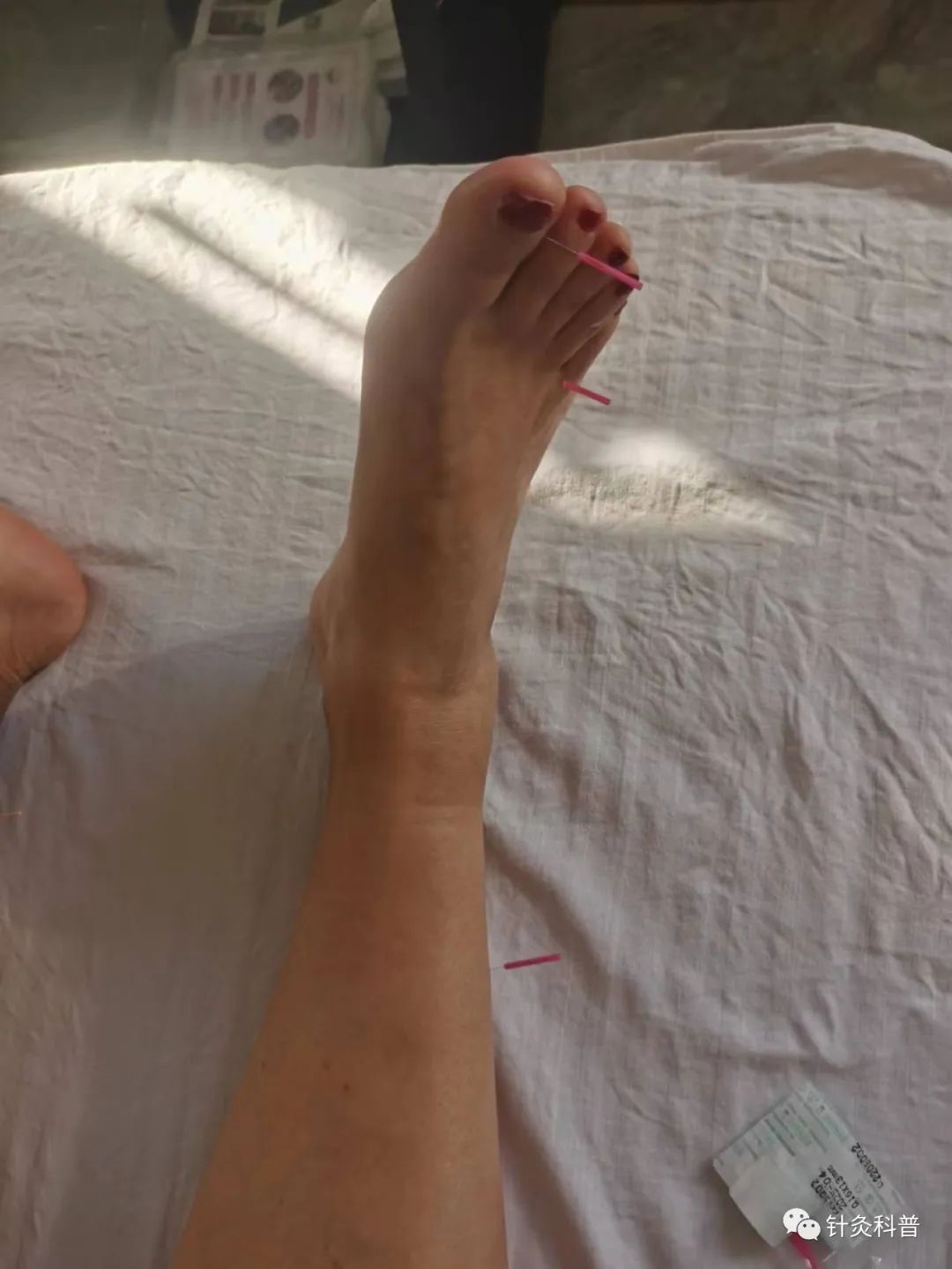 喉咙热有烧灼感针灸,舌头有烧灼感针灸方法