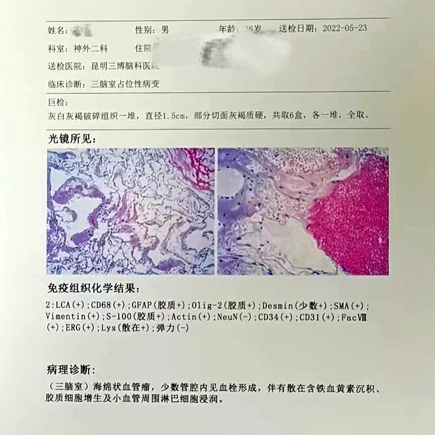 头部海绵状脑血管瘤3个办法消退,男子头痛查出心脏多个眼