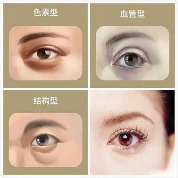 睡起来黑眼圈大是什么原因引起的,平时很早睡黑眼圈还是很重