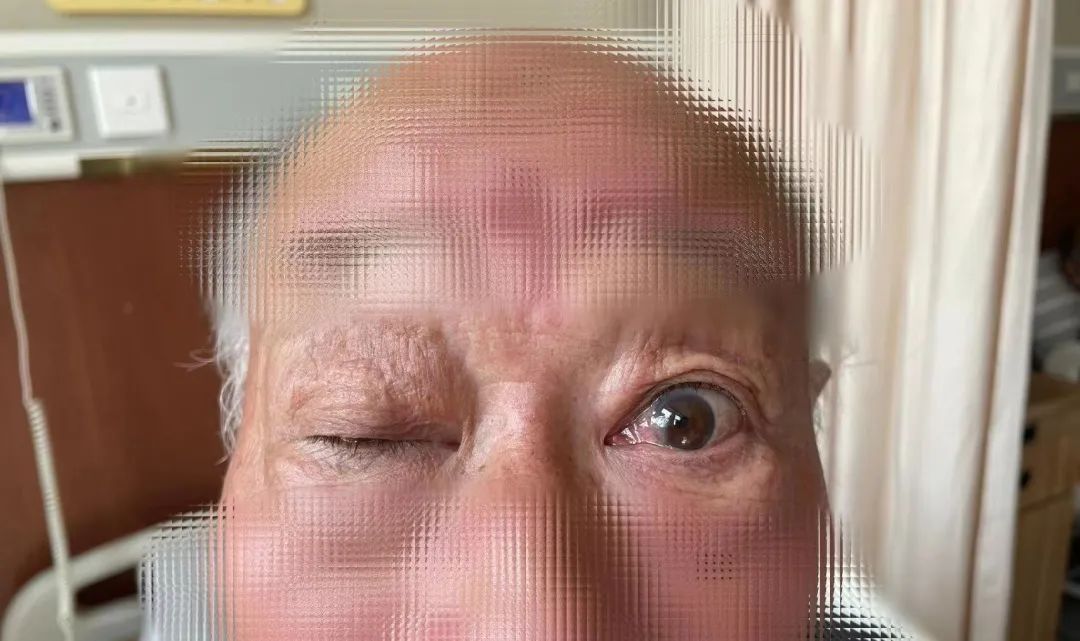 眼皮抬不起来吃什么药,眼皮抬不起来啥病