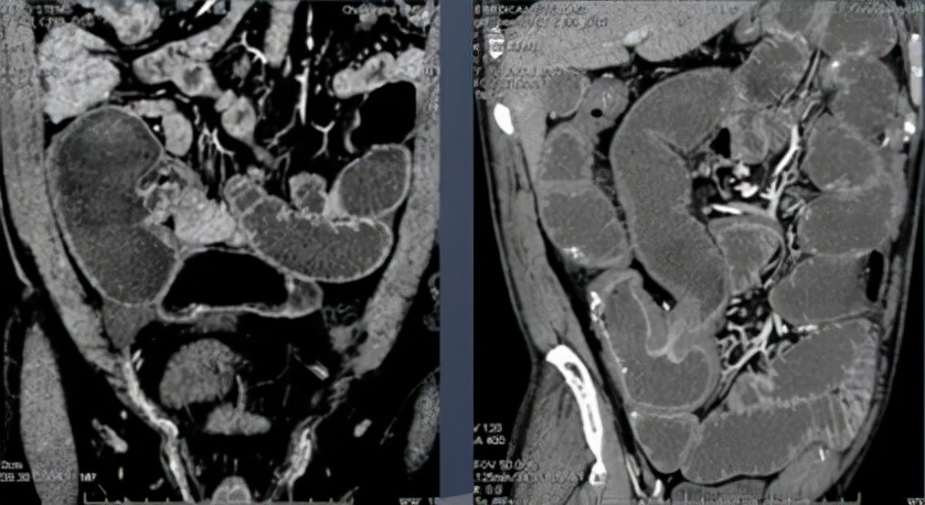 肺结核会传染给别人得肠结核吗,治疗肺结核的同时治疗肠结核吗