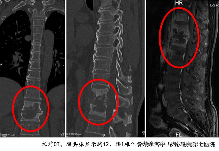 结核病菌“吃空”脊椎致腰痛难忍!人工智能辅助手术一次性解救“生命之柱”