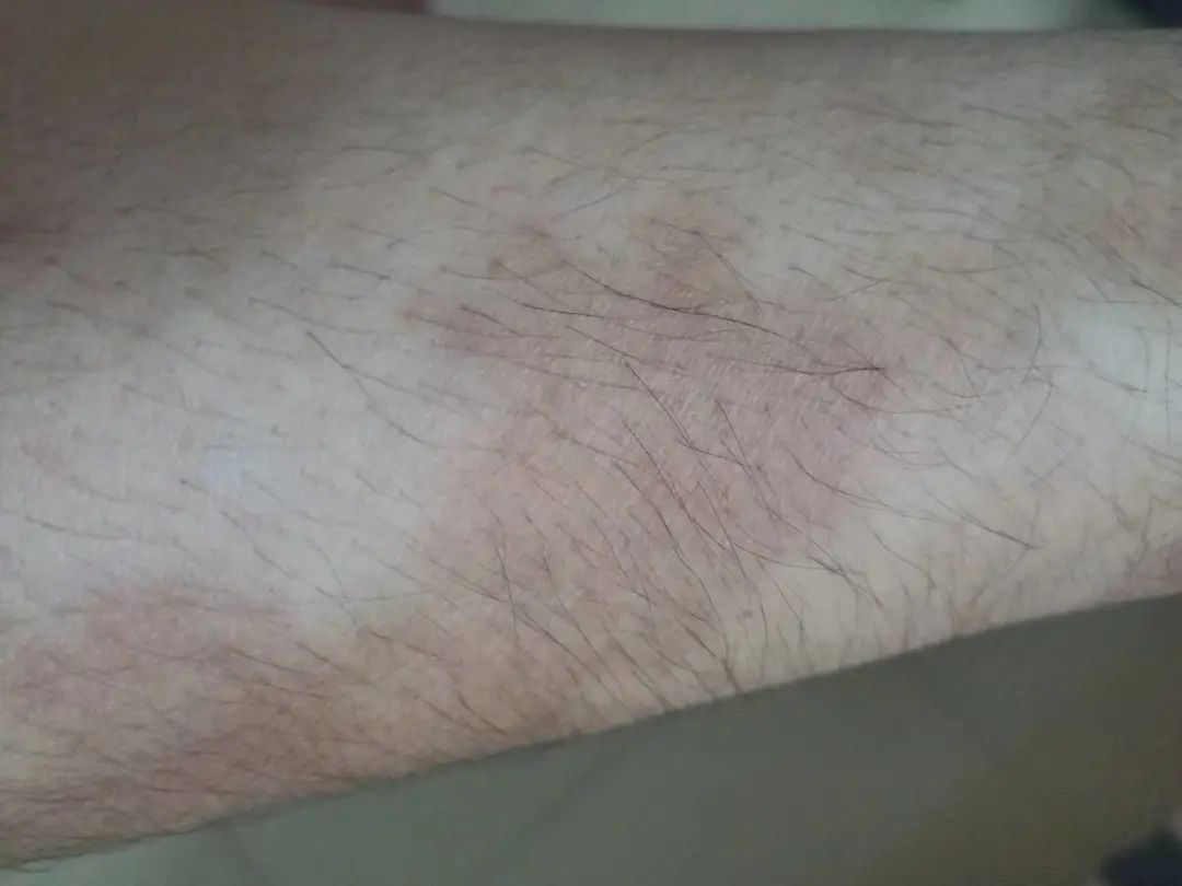 一睡醒，满床都是皮屑！“得了这病，剪发到一半就被赶出来”