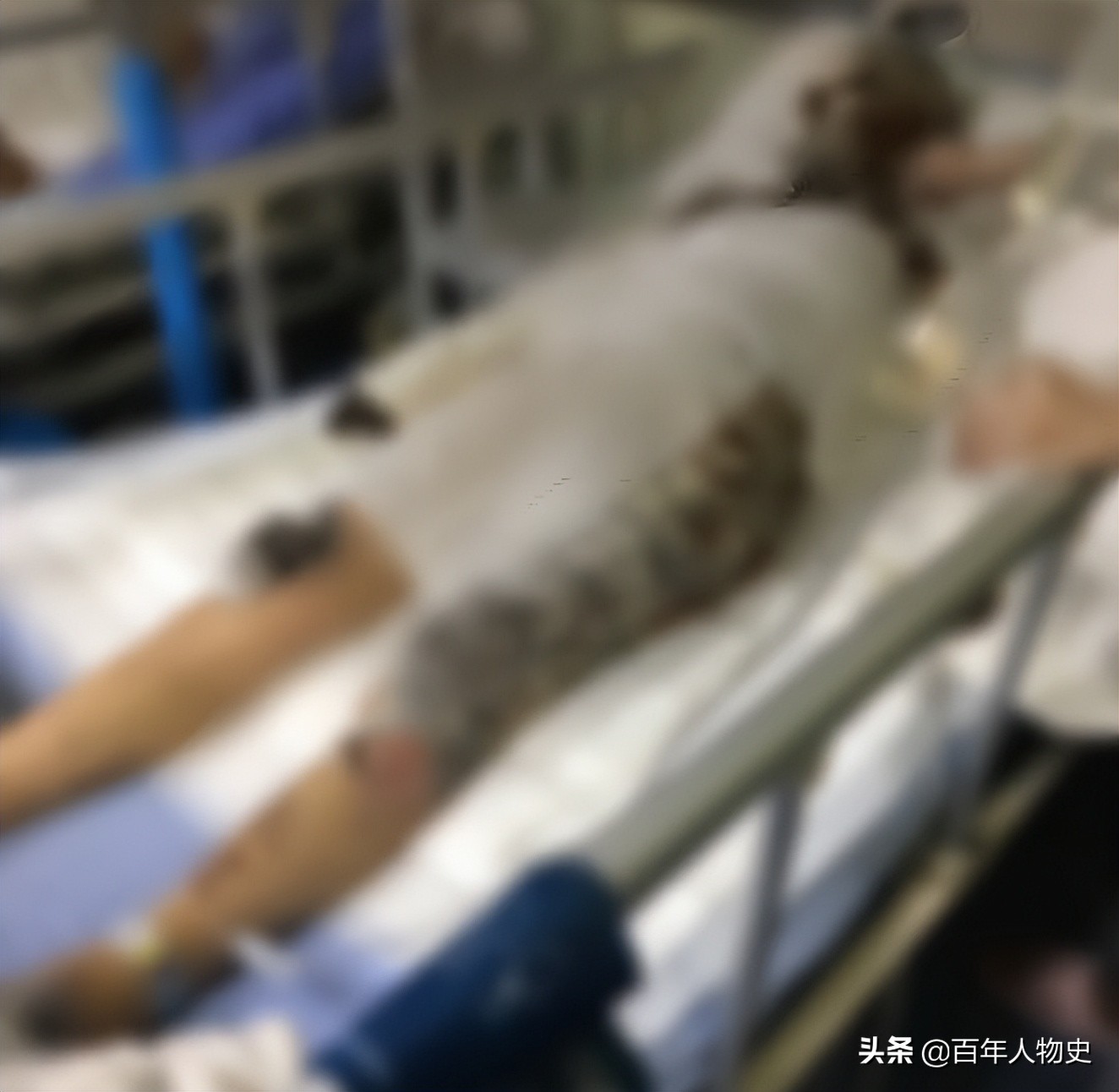 19年,四川20岁女孩遭大火毁容48%烧伤,双臂截肢如今怎么样了?