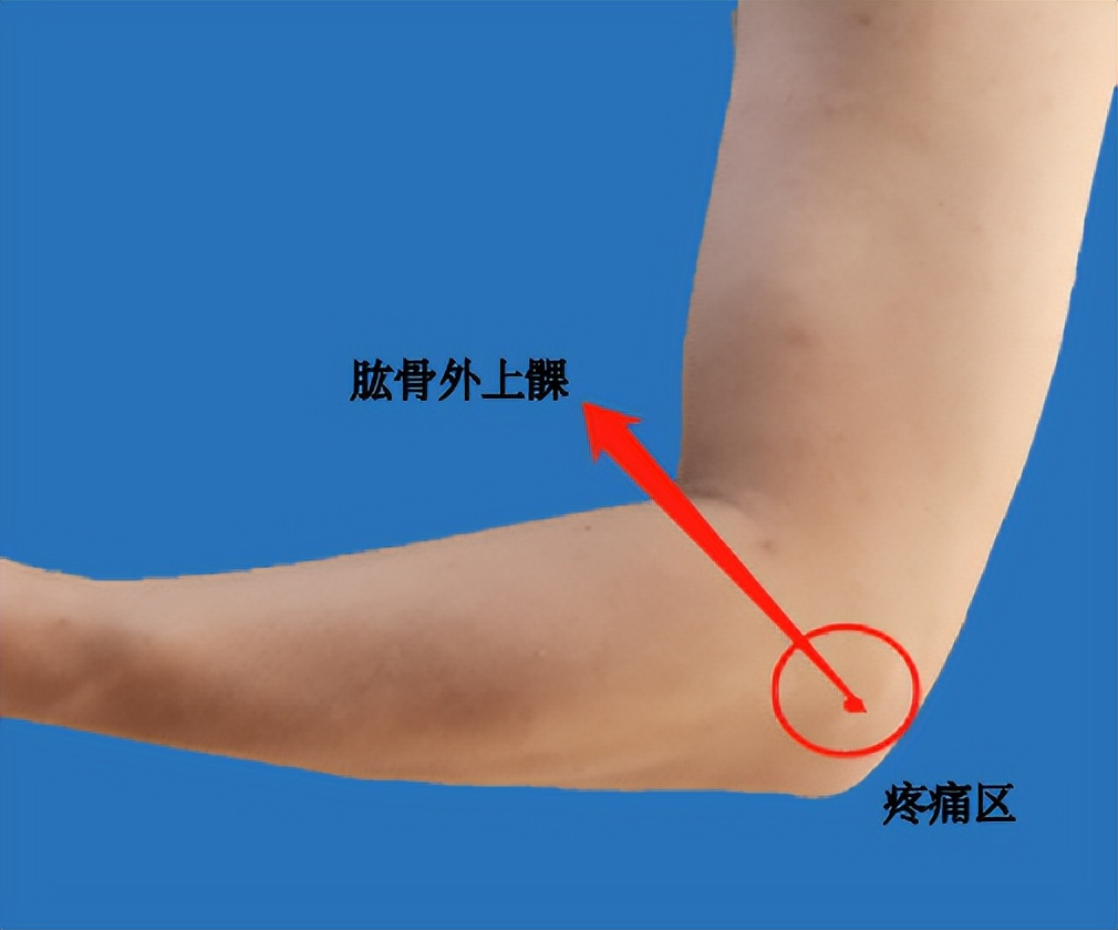 「筋骨堂」“网球肘”并非网球运动员的“专利”