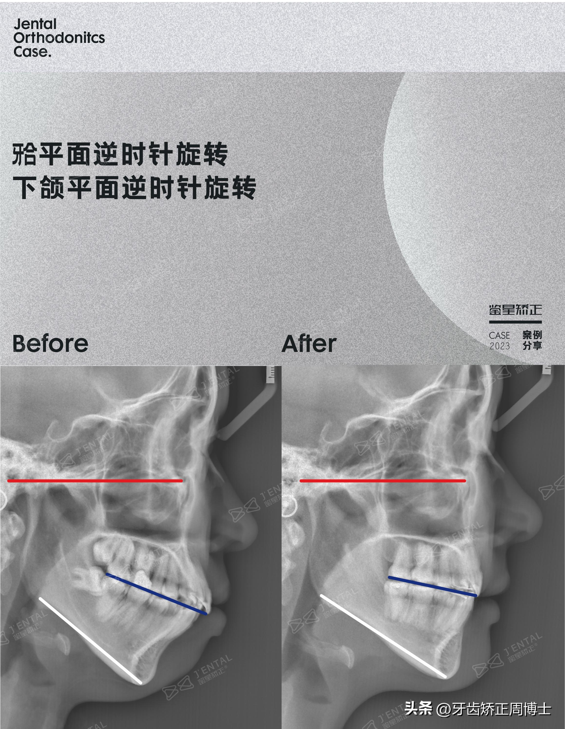 龅牙骨钉矫正演示,骨性龅牙打骨钉前后对比