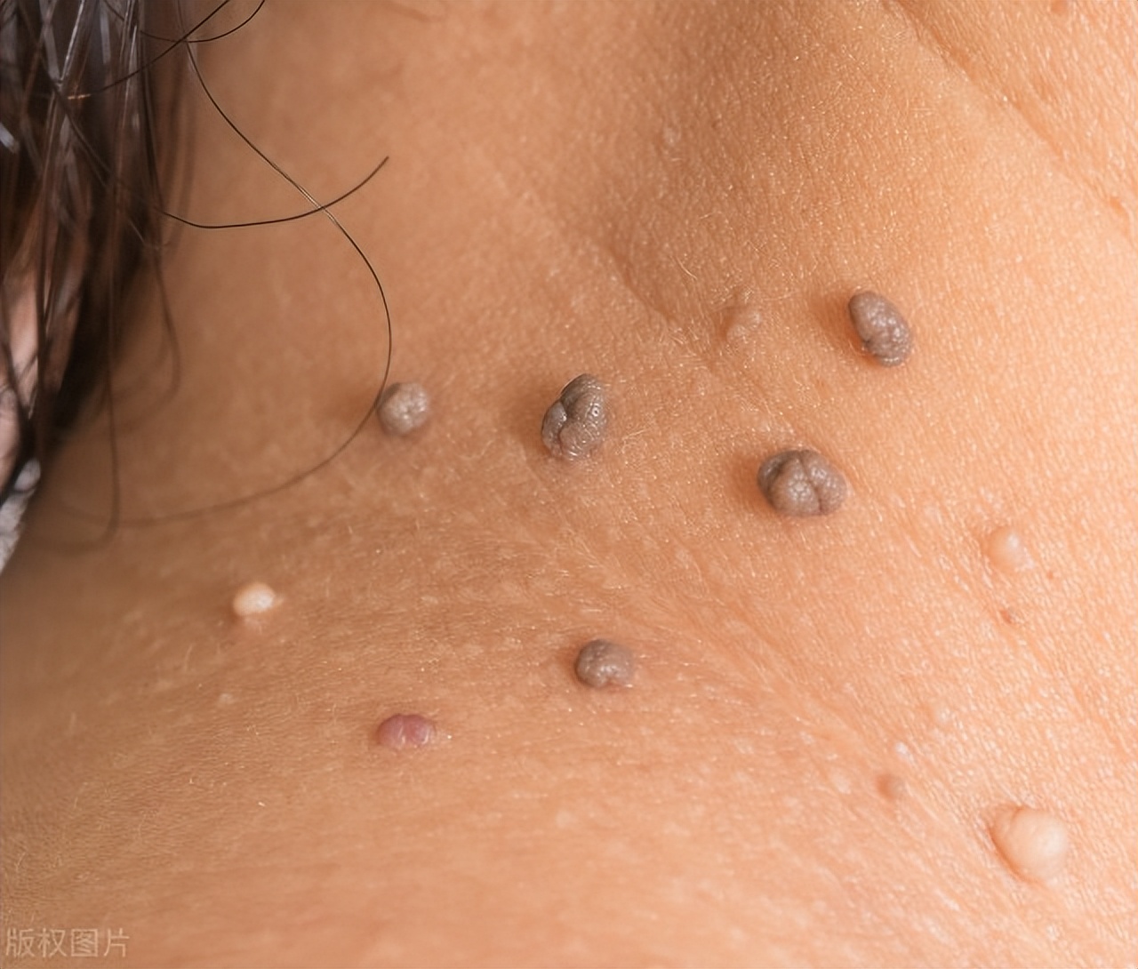 黑痣越来越多是癌吗,黑痣会越长越多吗