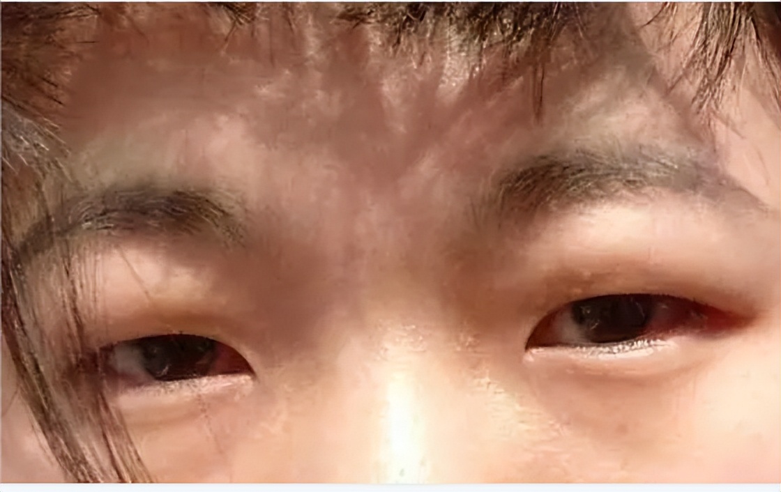 肿泡眼可以自然变成双眼皮吗,肿泡眼适合什么类型双眼皮