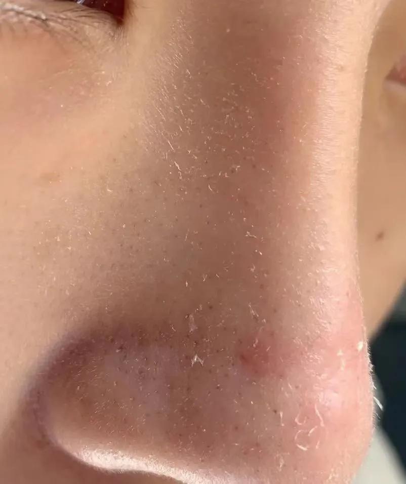 鼻子干燥起皮化妆怎么急救,妆后起皮卡粉怎么急救