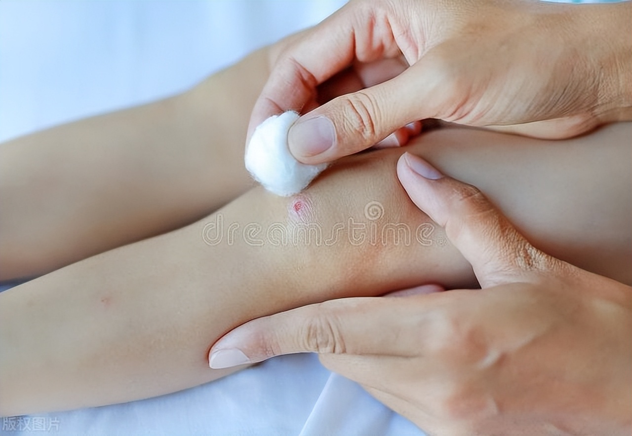 肺结节手术后伤口化脓感染了,术后伤口化脓感染不愈合怎么办