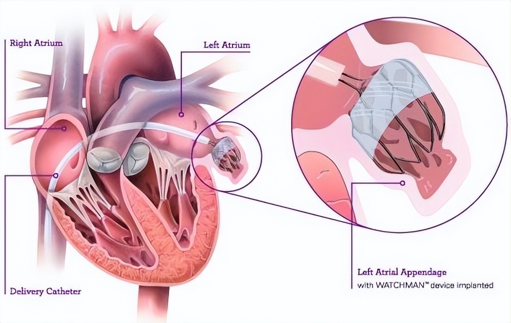 房颤最常见并发症是脑梗死吗,房颤引起的脑梗死怎么治