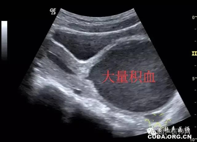 13岁女孩感觉尿不尽是什么原因,小女孩12岁尿不出来是咋回事