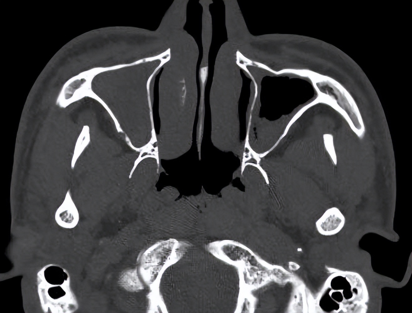 反复鼻塞,好不了,这次总算找到了原因