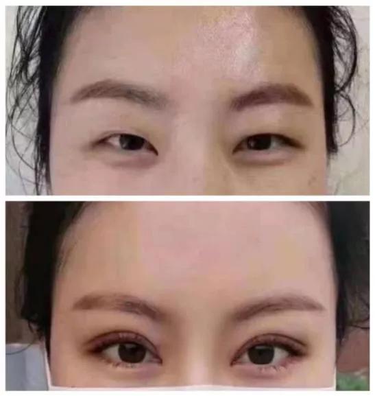 想割双眼皮怕失败,割双眼皮踩雷了应该找医院吗