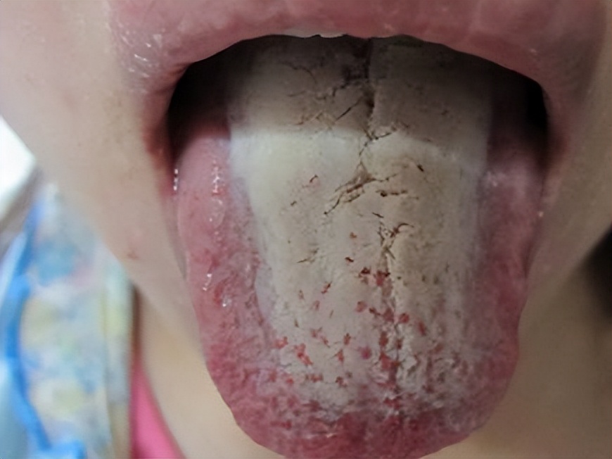 口臭太严重怎么办刷牙都没用,一招解决口臭口腔异味