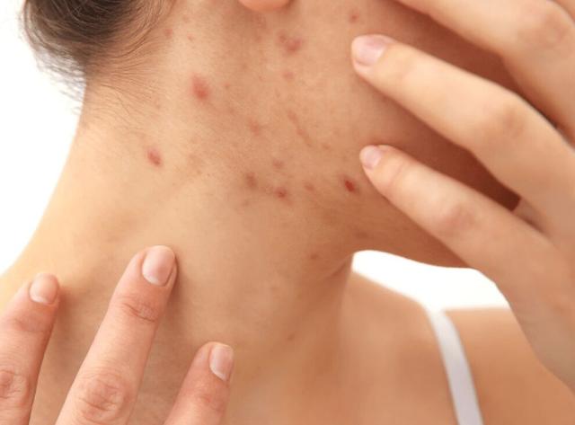 艾滋病出现的皮肤病不治会自愈吗,艾滋病潜伏期会单纯出现皮肤病吗