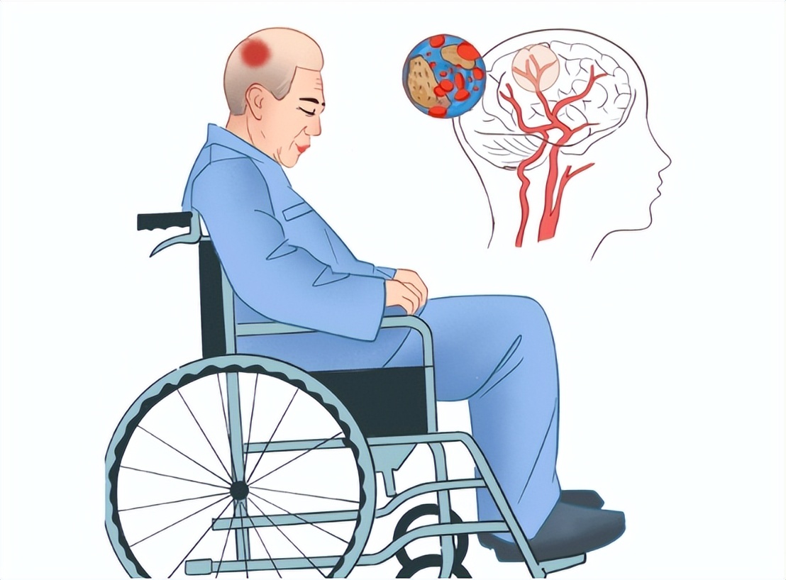 缺血性脑卒中中医治疗原则,急性缺血性脑卒中诊治指南最新版