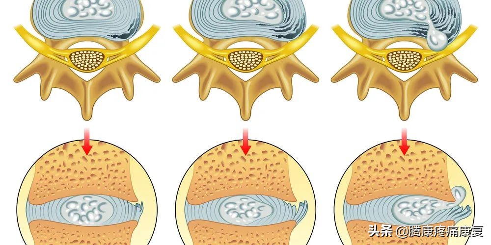 腰5骶1椎间盘突出可以跑步锻炼吗,腰4-5椎间盘突出手术需要多少钱