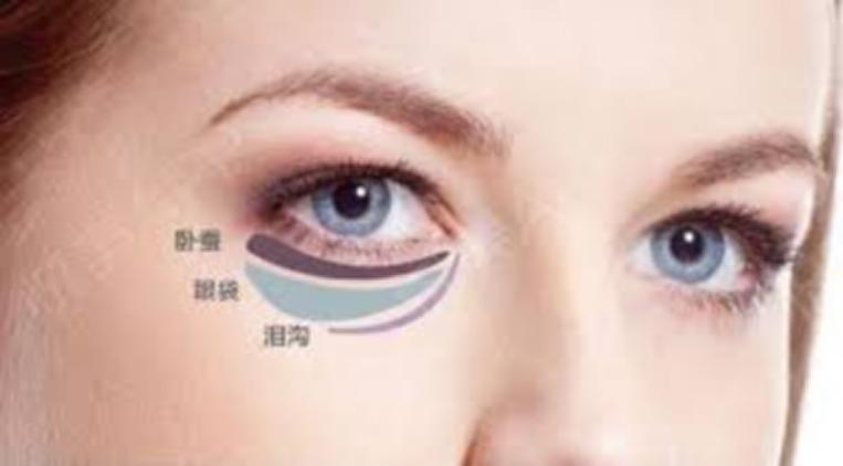 眼袋和卧蚕修复,眼袋大很显老一招眼袋变卧蚕