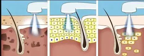 光子嫩肤哪个好,光子嫩肤哪种光波最好