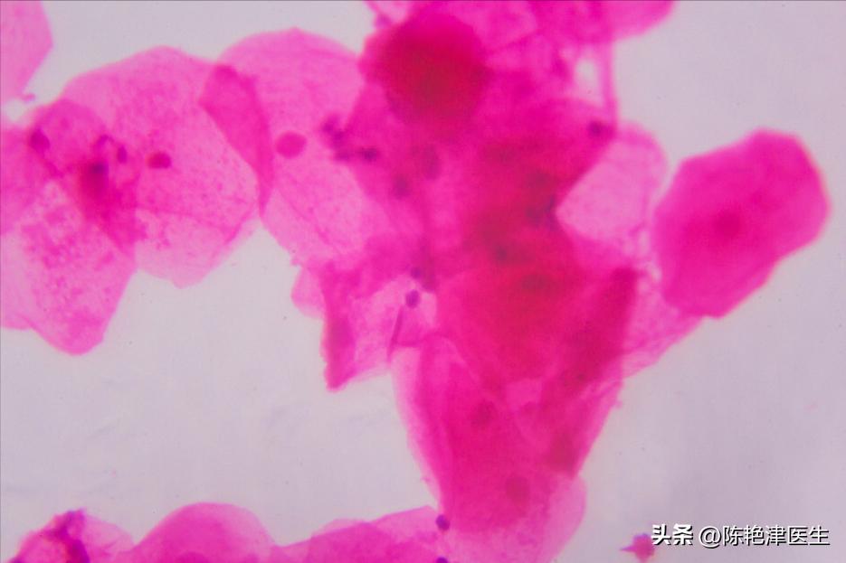 赵忠祥鳞状细胞癌早期症状,赵忠祥鳞状细胞癌有什么症状