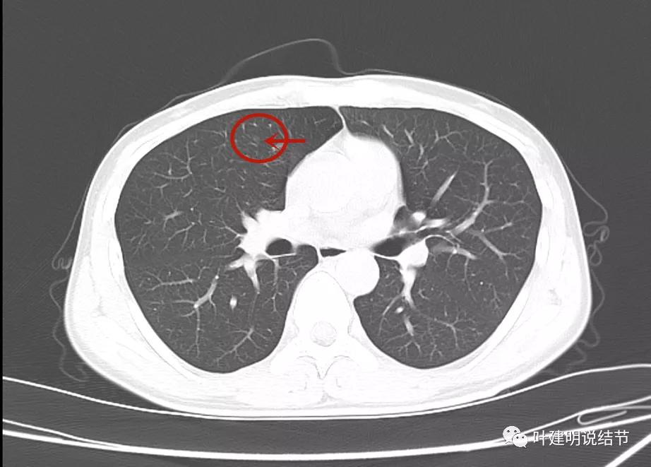 这样的多发病灶给试验性抗结核治疗?消失的结节是药的功劳吗?