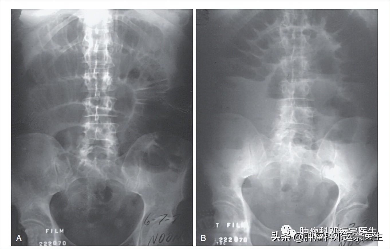 小肠梗阻的诊断与治疗,小肠梗阻最好治疗方法