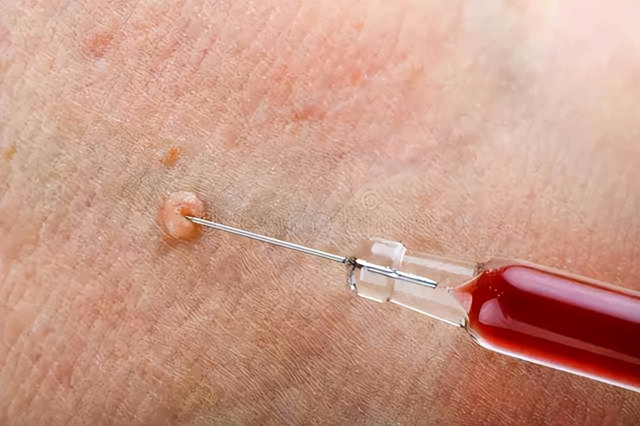 皮肤长“小肉球”是咋回事，可以用手抠掉吗？如何处理？一文看懂