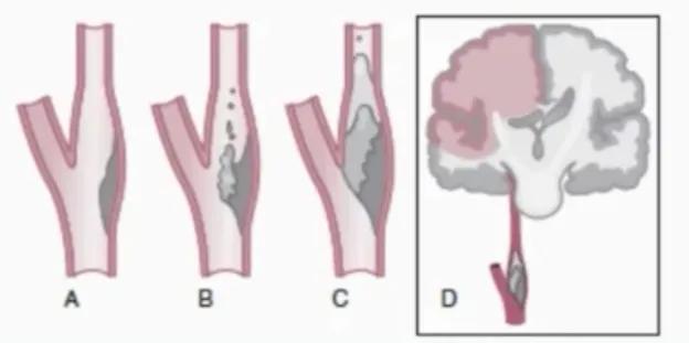 缺血性卒中治疗原则,缺血性卒中病因分型