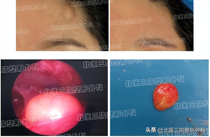 额头上长了个硬疙瘩很疼怎么办,额头上长了一个硬疙瘩是怎么回事