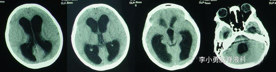 儿童结核脑膜炎脑积水,结核性脑膜炎脑积水如何引起