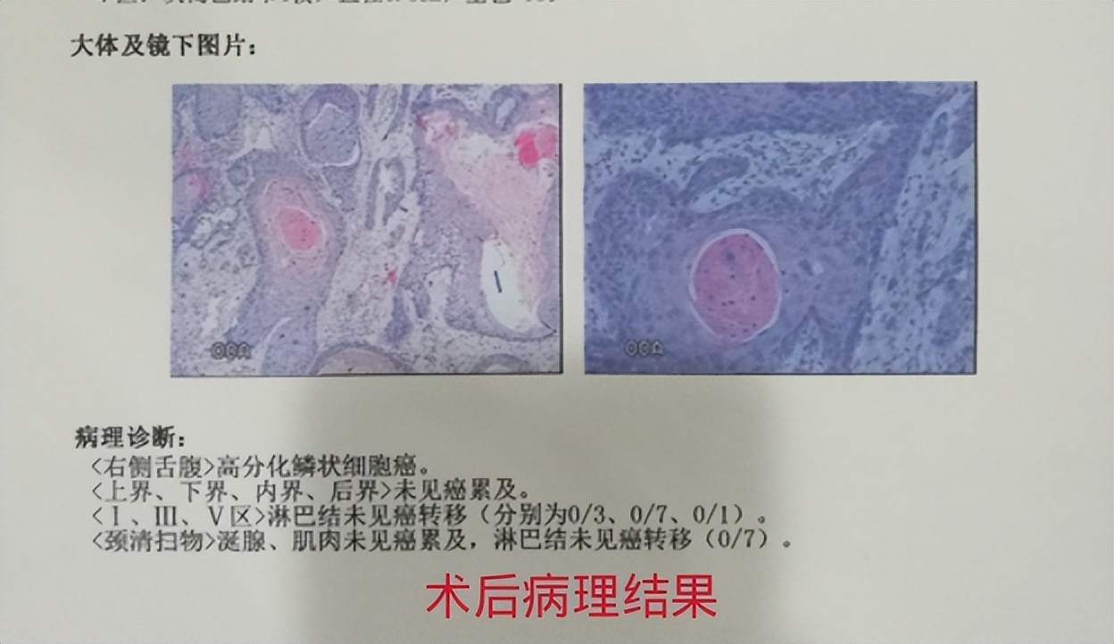 舌头一侧溃疡咽喉癌,舌头溃疡严重会是癌吗