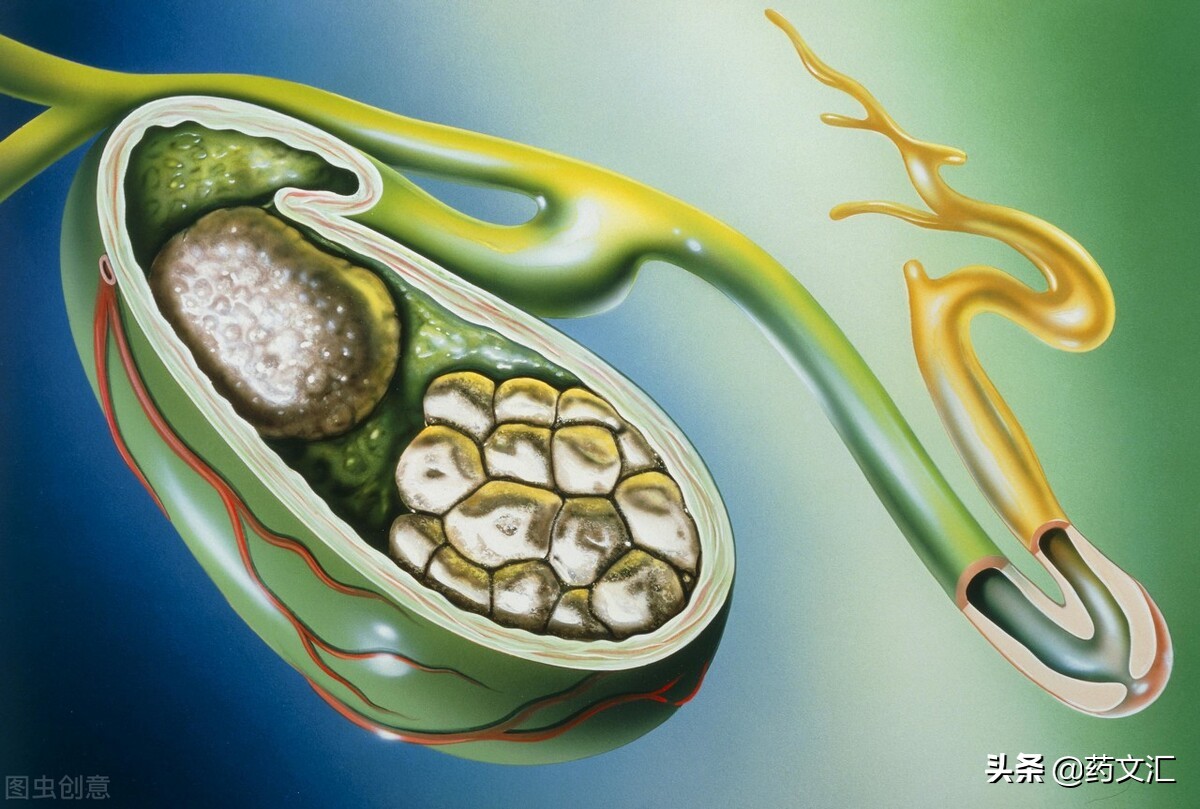 肝胆湿热经方治疗胆结石,胆结石湿热肝郁怎么治