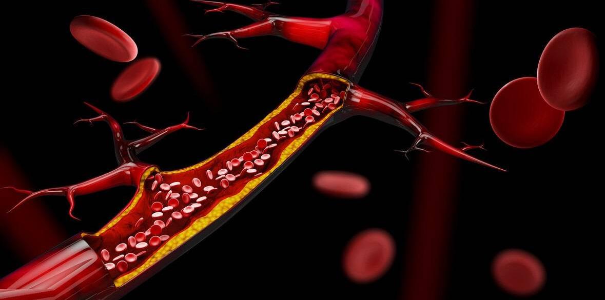 胆固醇升高身体要遭殃？教你4招，击退高血脂，平稳胆固醇