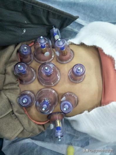 中医药防控近视眼技术培训,中医适宜技术防控近视实施方案