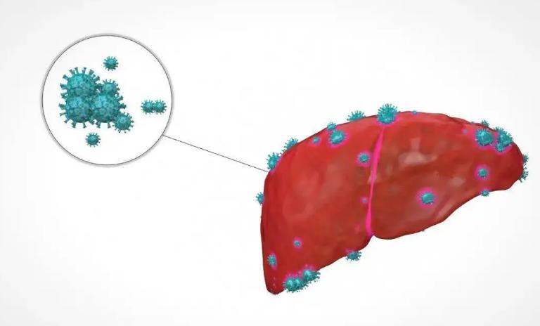 乙肝肝火旺盛怎么调理,乙肝自愈的最佳办法