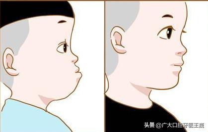 地包天的儿童怎么办,孩子地包天矫正有什么后遗症