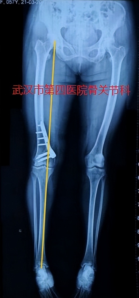 膝关节炎阶梯治疗专家共识,了解膝关节炎的预防和治疗很关键