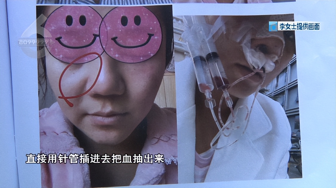 鼻子整形后流脓是不是医疗事故,鼻子整容后流脓怎么处理