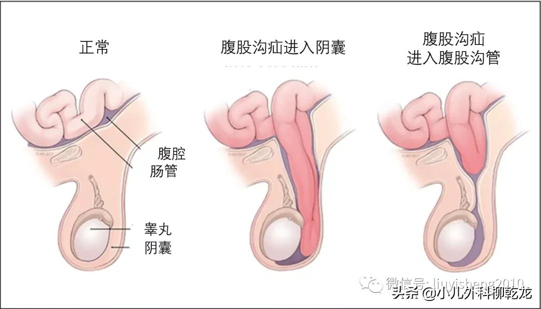 一个月宝宝疝气哭闹怎么办,三个月宝宝有疝气总是哭怎么办
