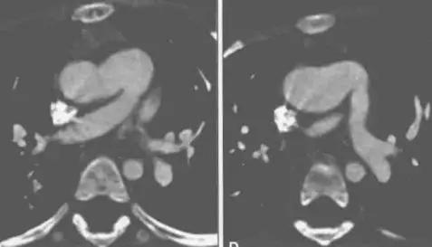 主肺动脉间隔缺损宝宝,主肺动脉间隔缺损的类型有