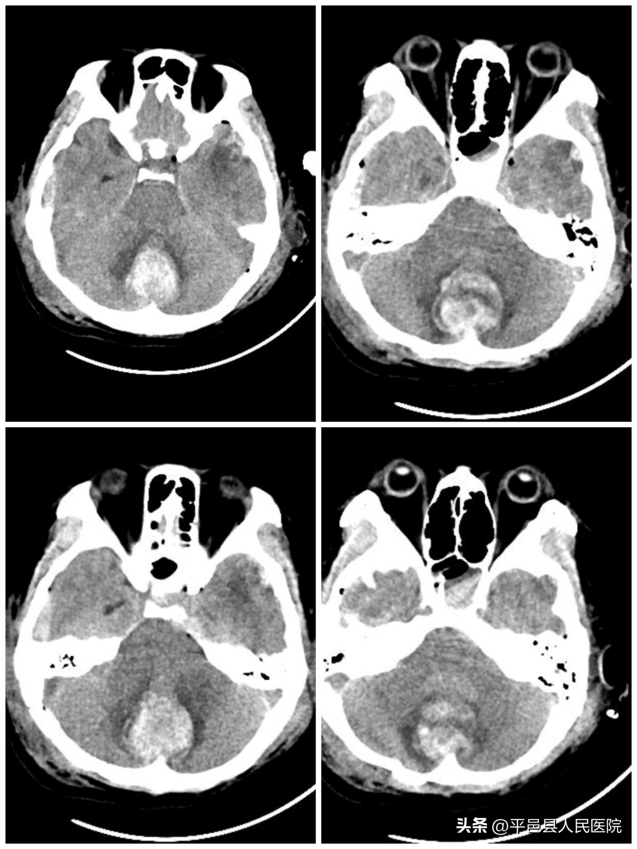 双十年华突发严重多发外伤多科协作联合手术成功救治