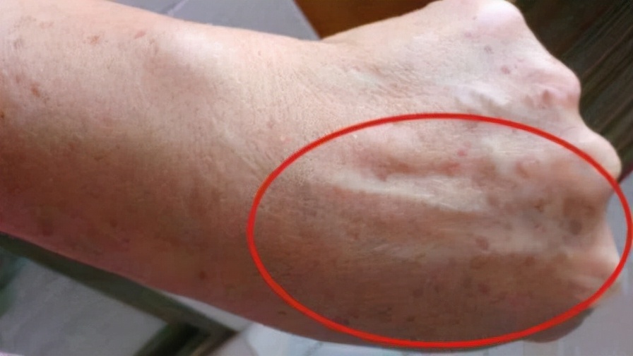 人为什么会长老人斑？红霉素软膏可以去除老人斑？本文告诉你真相