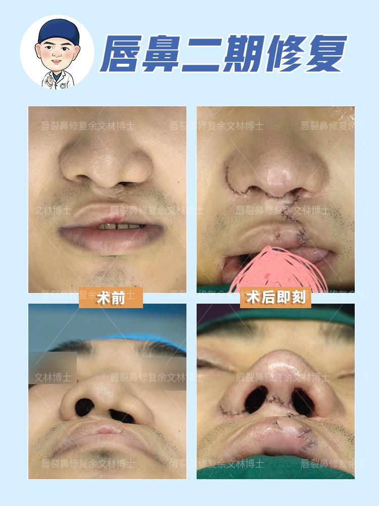 鼻子畸形堵住了怎么治？唇裂继发鼻畸形的患者可以这样做