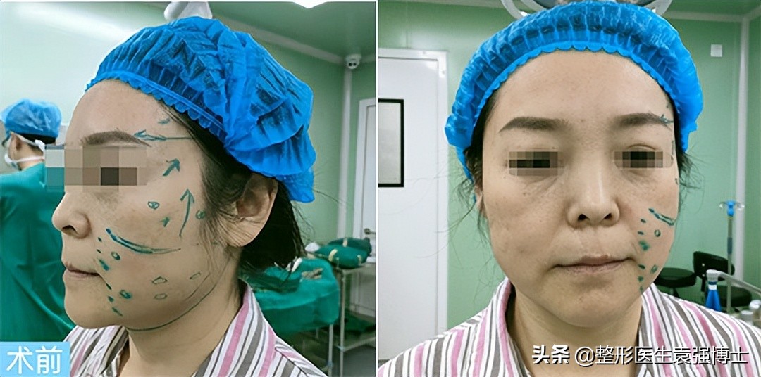 小拉皮20天恢复效果图,拉皮手术后75天复查