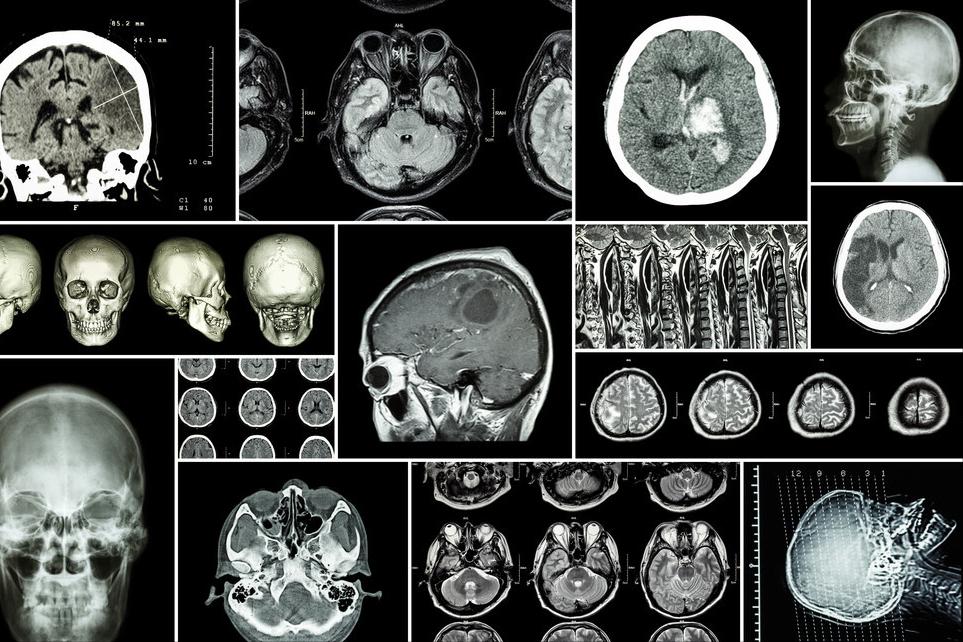 短暂性脑缺血发作如何有效治疗,短暂性的脑缺血怎么急救