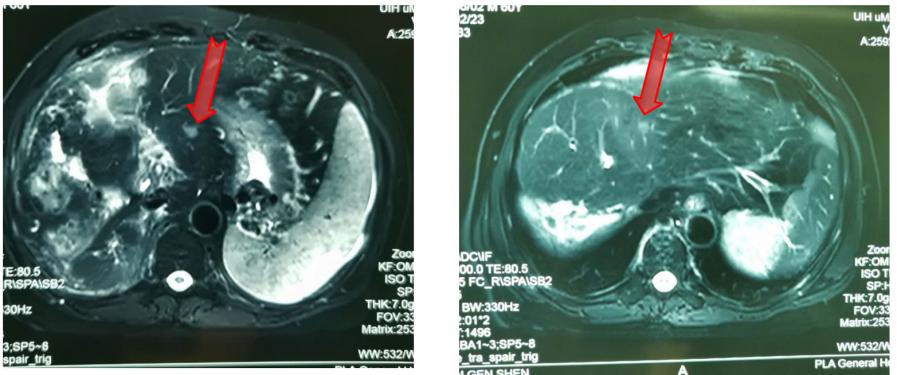 放疗肝内胆管细胞癌能治好吗,放疗治疗肝门静脉癌栓