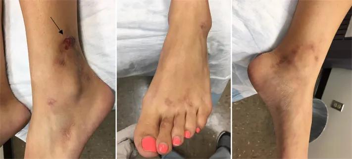 青斑血管病可以治愈吗,青斑是皮肤病还是血管病