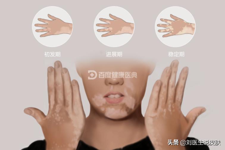 一篇文章总结：白癜风为什么边治疗边发展？分享最有效的控制方法